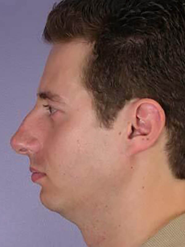 Rhinoplasty Before & After Image