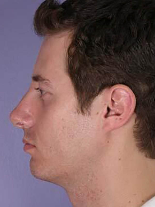 Rhinoplasty Before & After Image