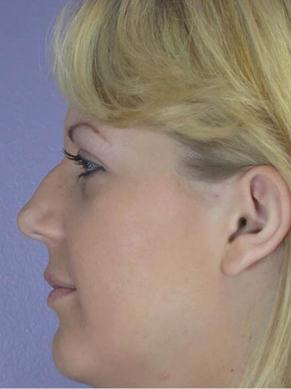 Rhinoplasty Before & After Image