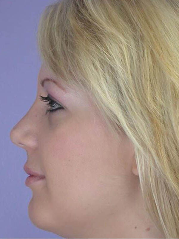 Rhinoplasty Before & After Image