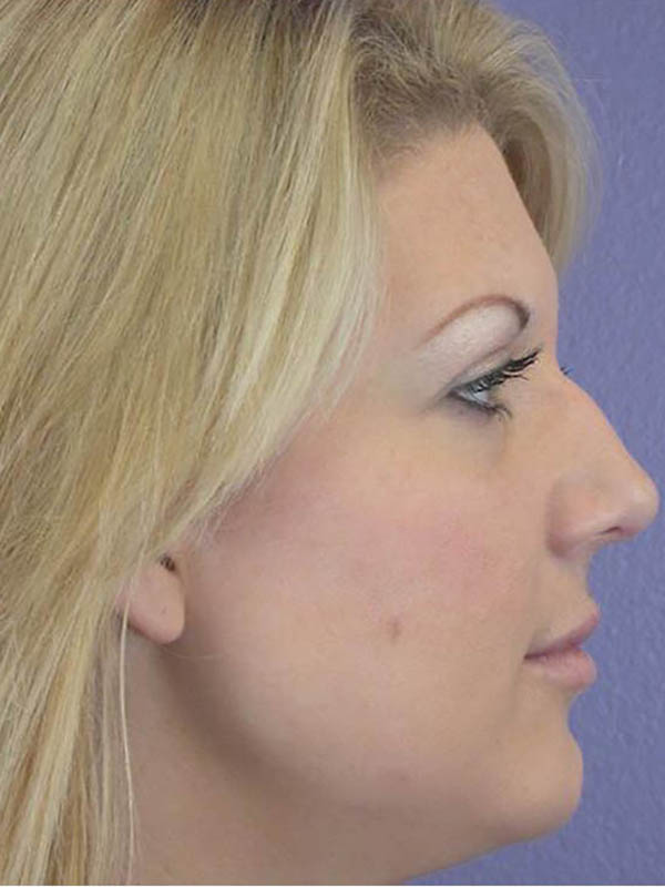 Rhinoplasty Before & After Image