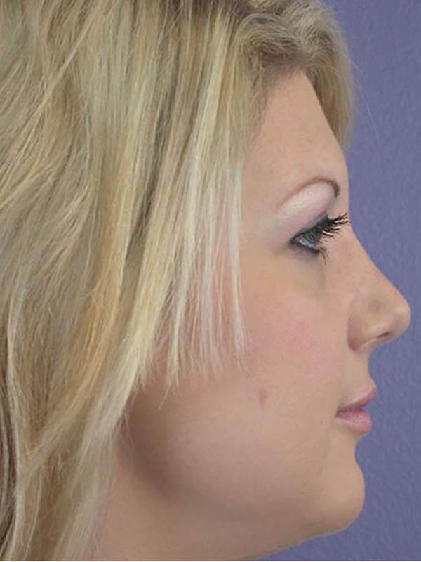 Rhinoplasty Before & After Image