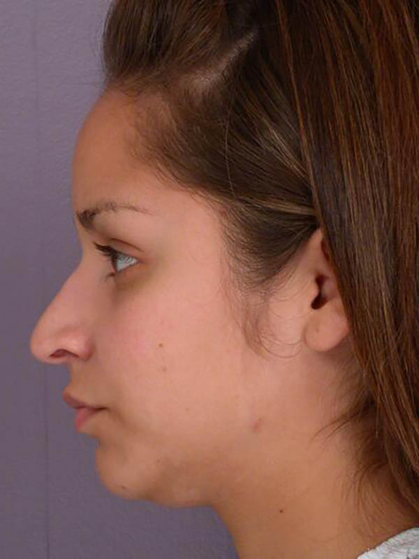 Rhinoplasty Before & After Image