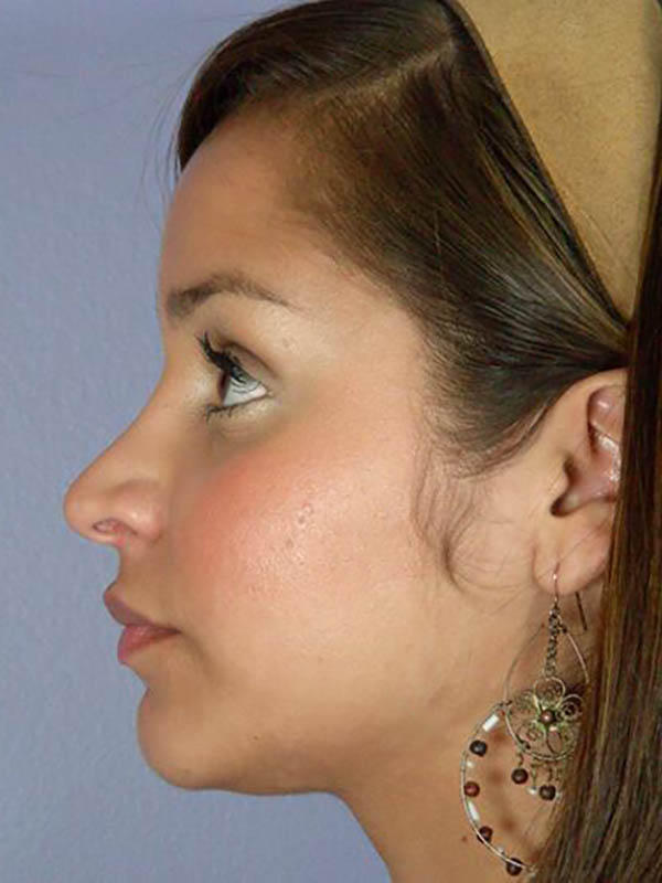 Rhinoplasty Before & After Image