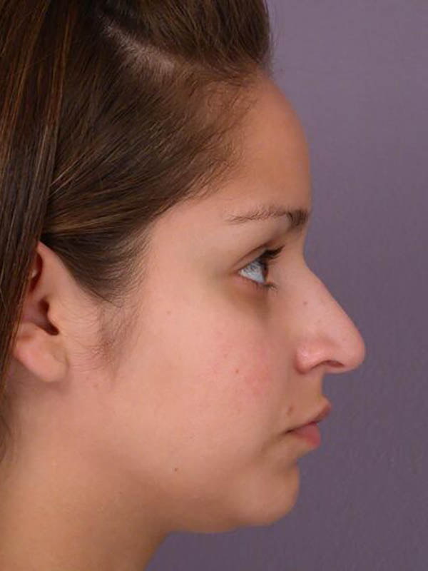 Rhinoplasty Before & After Image