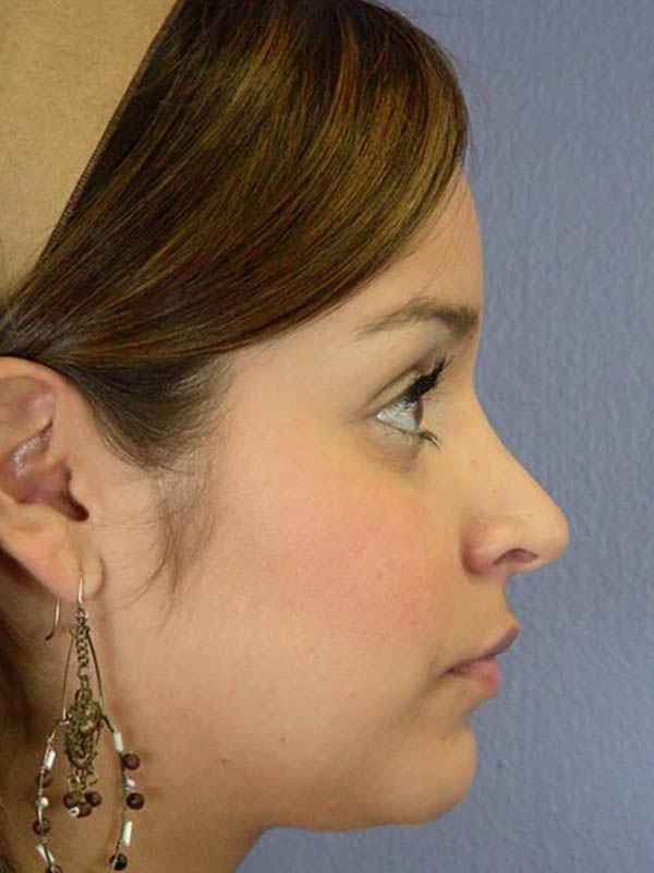 Rhinoplasty Before & After Image