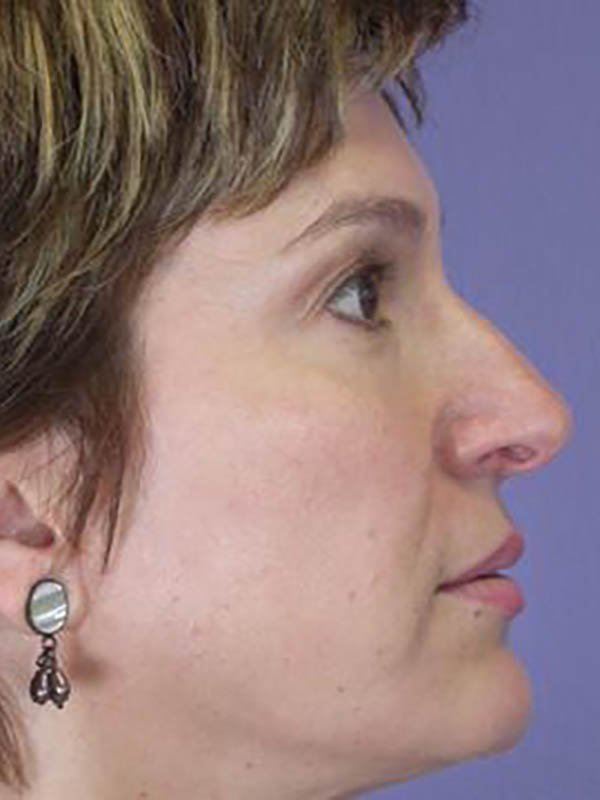 Rhinoplasty Before & After Image