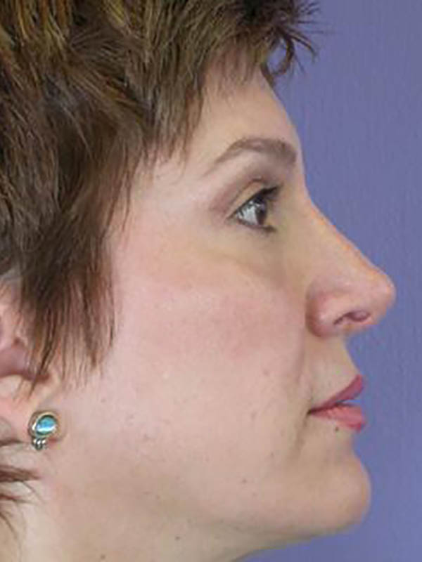 Rhinoplasty Before & After Image