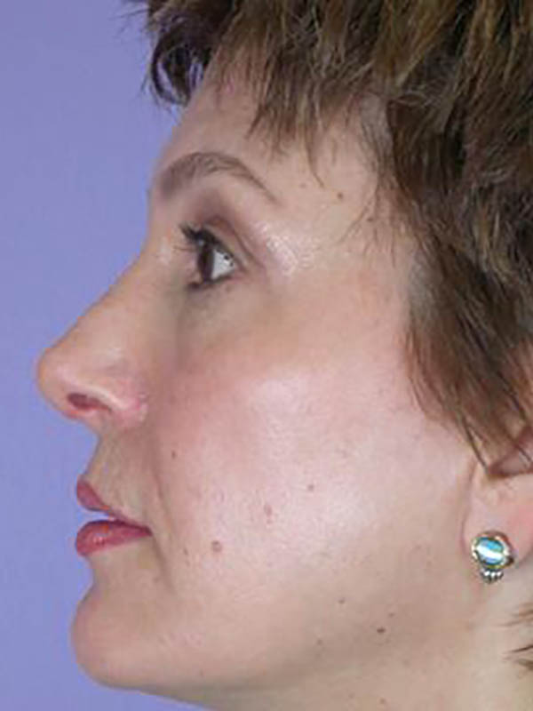 Rhinoplasty Before & After Image