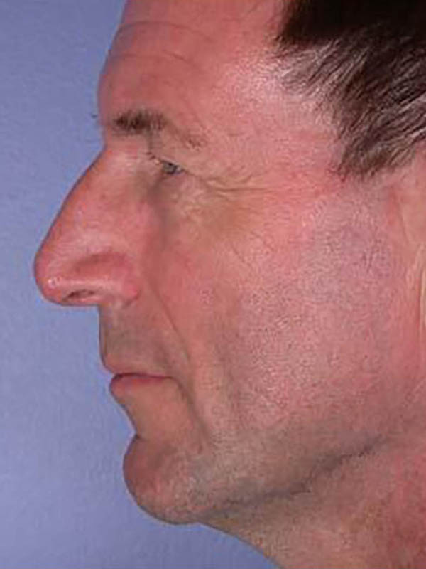 Rhinoplasty Before & After Image