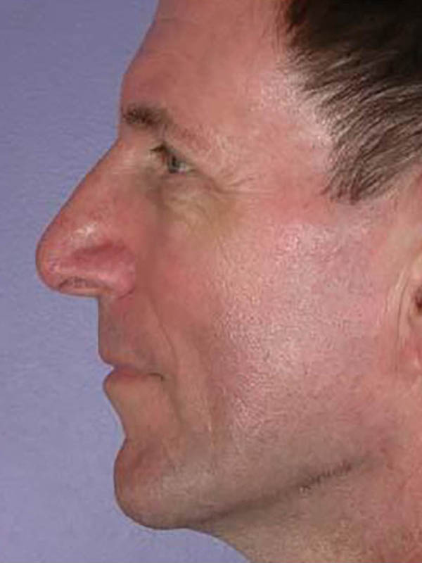 Rhinoplasty Before & After Image