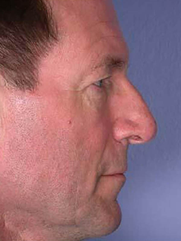 Rhinoplasty Before & After Image