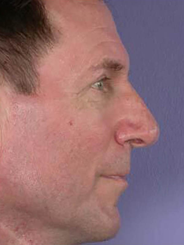 Rhinoplasty Before & After Image