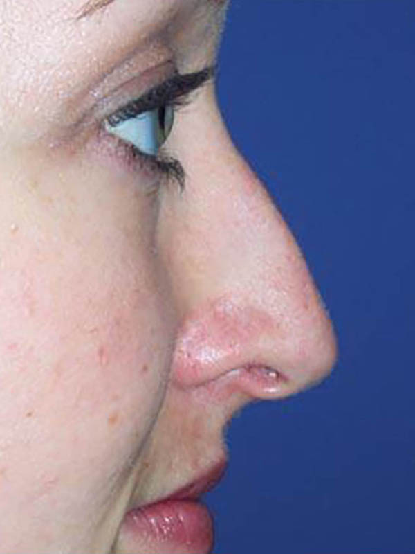 Rhinoplasty Before & After Image