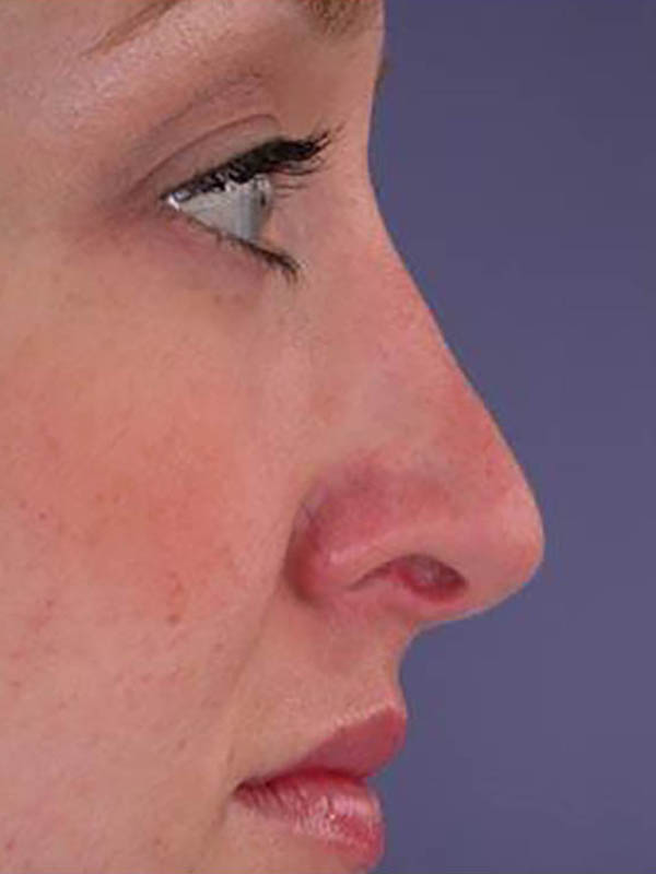 Rhinoplasty Before & After Image