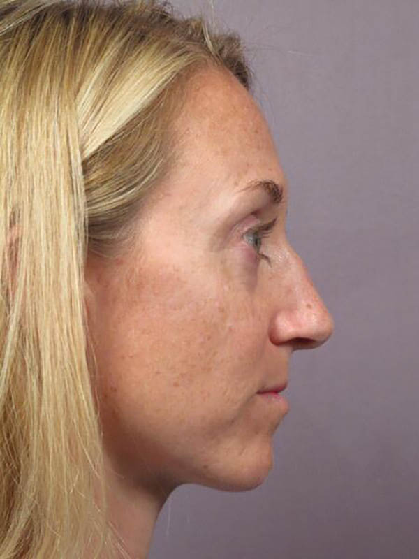 Rhinoplasty Before & After Image