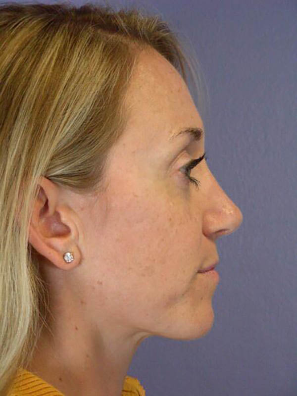 Rhinoplasty Before & After Image