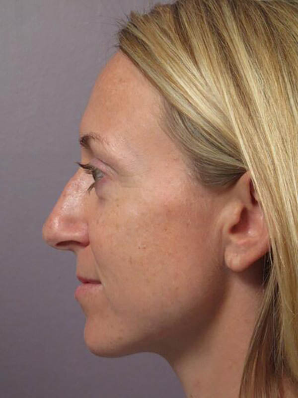 Rhinoplasty Before & After Image