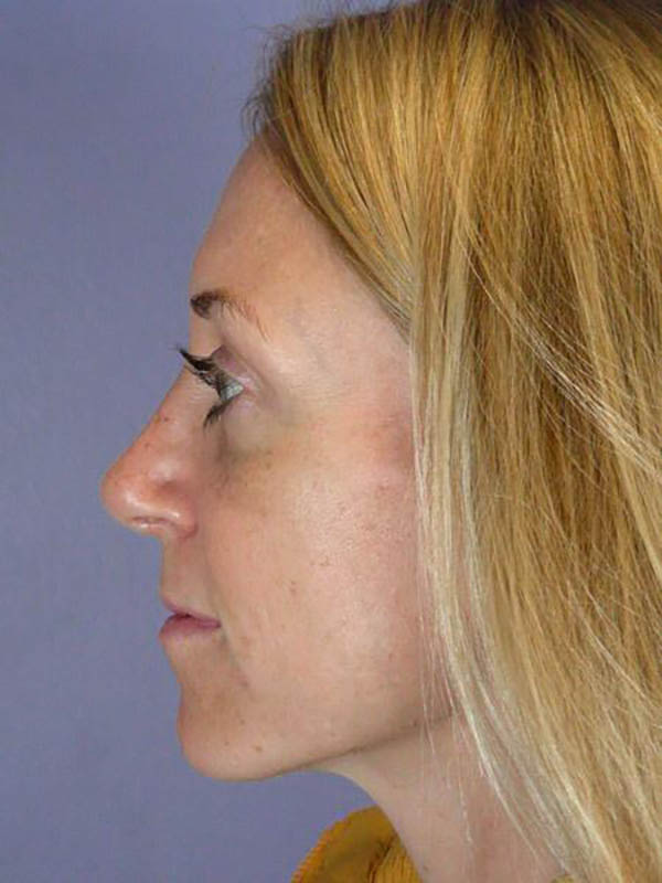 Rhinoplasty Before & After Image