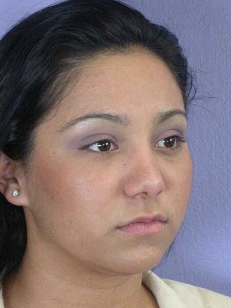 Rhinoplasty Before & After Image