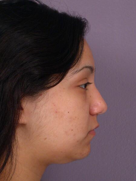 Rhinoplasty Before & After Image