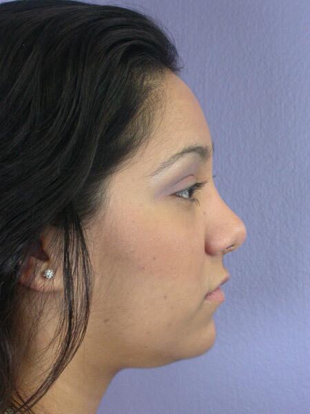 Rhinoplasty Before & After Image