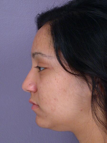 Rhinoplasty Before & After Image