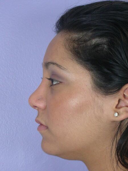 Rhinoplasty Before & After Image