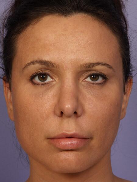 Rhinoplasty Before & After Image