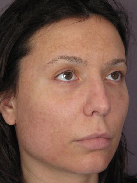 Rhinoplasty Before & After Image