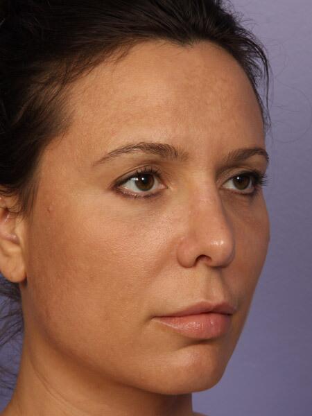 Rhinoplasty Before & After Image