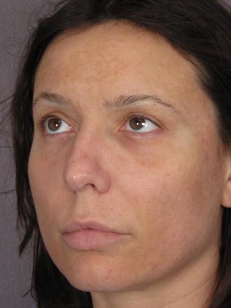 Rhinoplasty Before & After Image