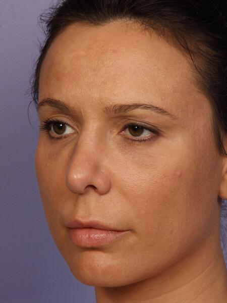 Rhinoplasty Before & After Image