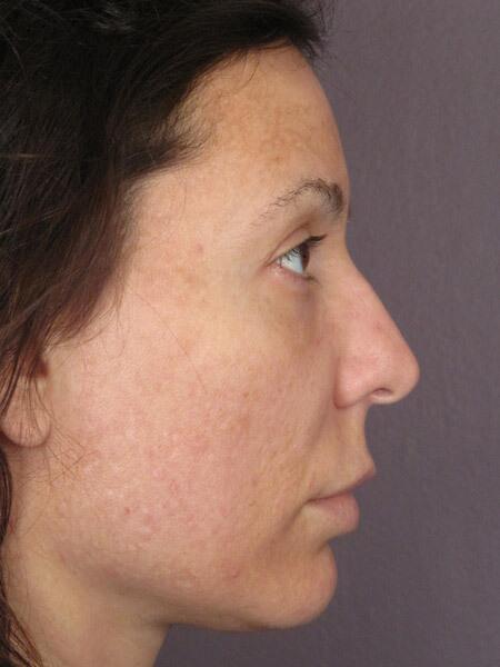 Rhinoplasty Before & After Image