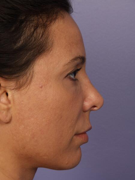 Rhinoplasty Before & After Image