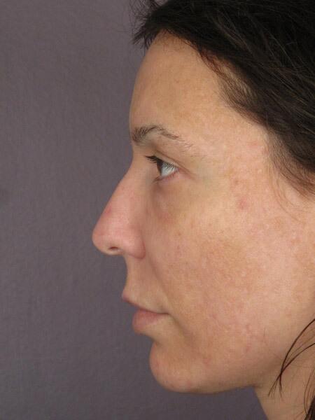 Rhinoplasty Before & After Image