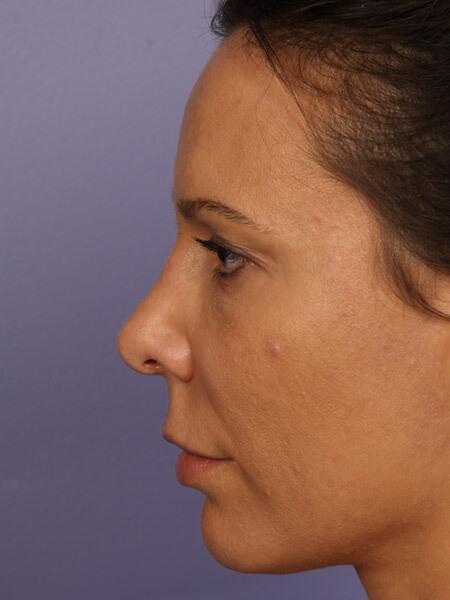 Rhinoplasty Before & After Image