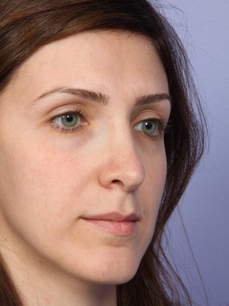 Rhinoplasty Before & After Image