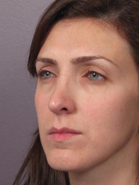 Rhinoplasty Before & After Image