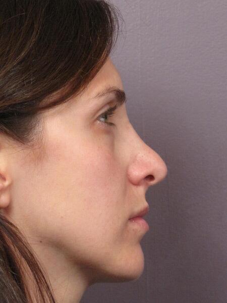 Rhinoplasty Before & After Image