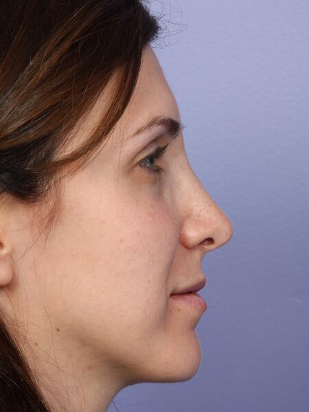 Rhinoplasty Before & After Image