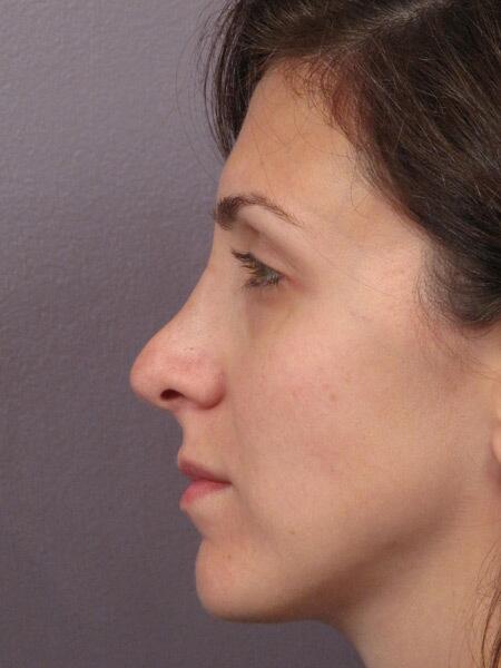 Rhinoplasty Before & After Image