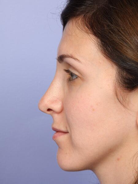 Rhinoplasty Before & After Image