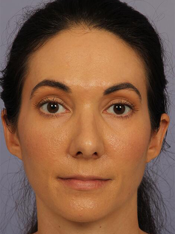 Rhinoplasty Before & After Image