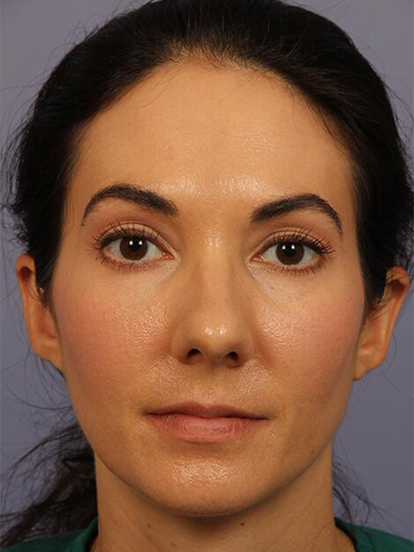 Rhinoplasty Before & After Image