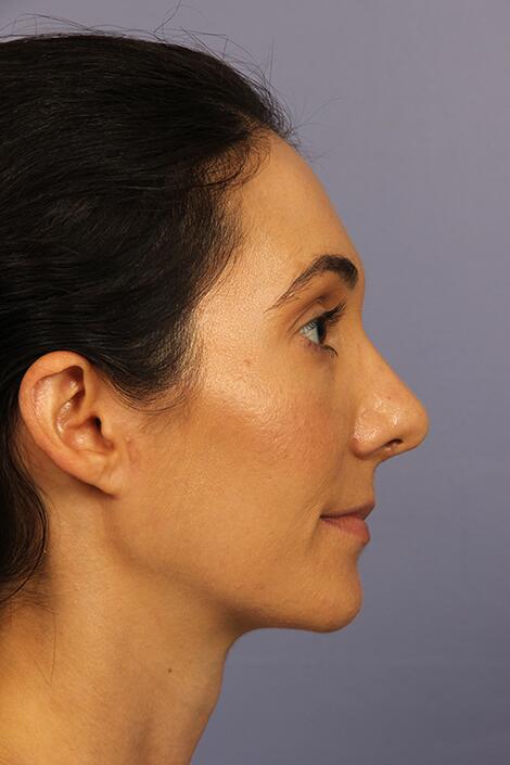 Rhinoplasty Before & After Image