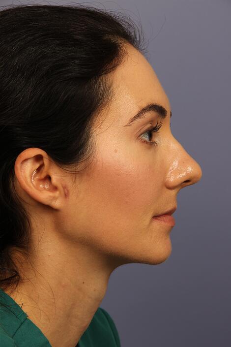 Rhinoplasty Before & After Image