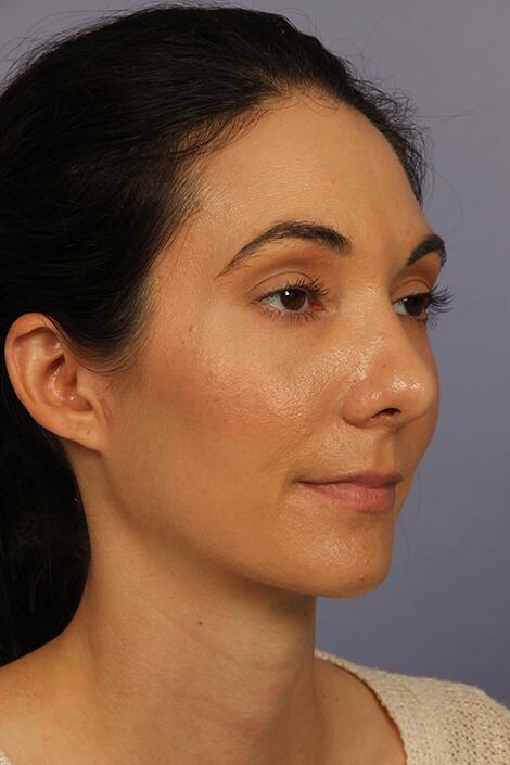 Rhinoplasty Before & After Image