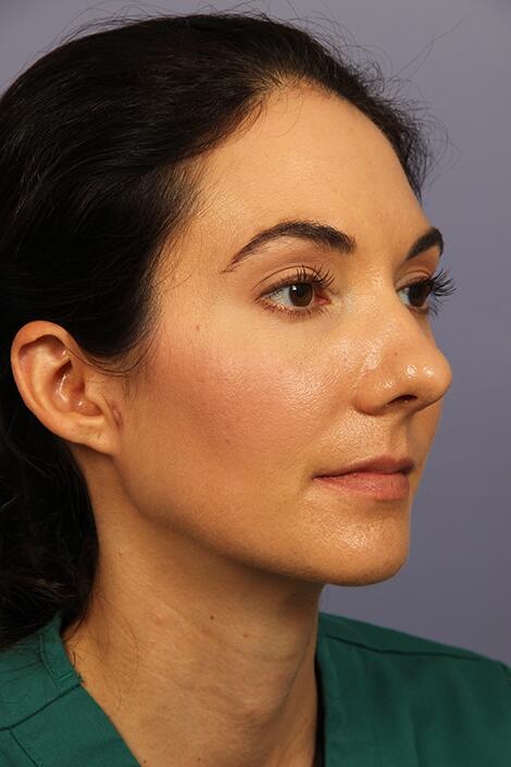 Rhinoplasty Before & After Image