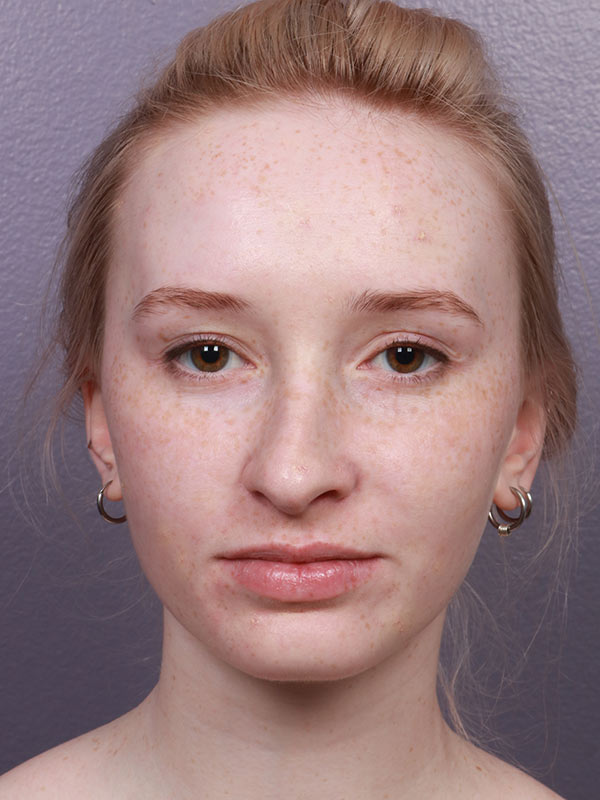 Rhinoplasty Before & After Image